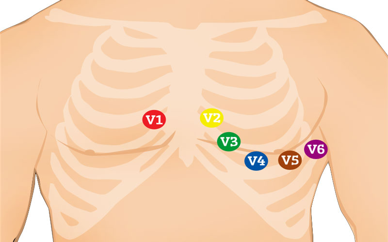 محل اتصال پوآر ECG